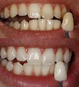 voor en na behandeling tanden bleken